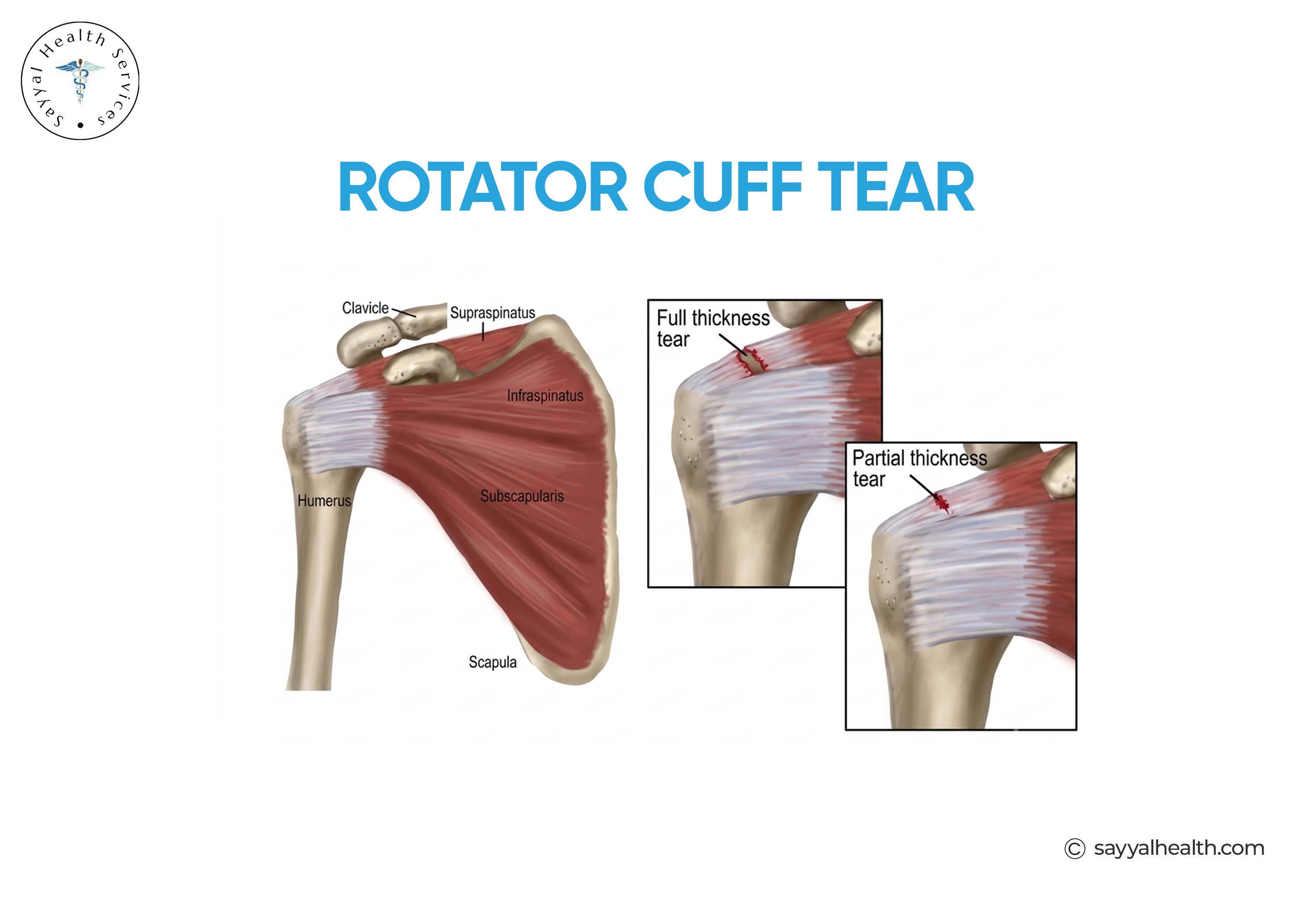 rotator cuff tear